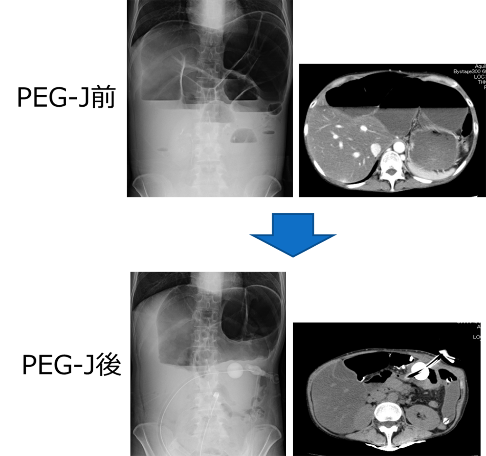 図７．PEG-J前と後の違い（PEG-J後は小腸拡張が改善していることがわかる）